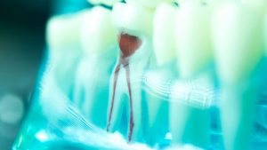 Root Canals: How Long Do They Last?