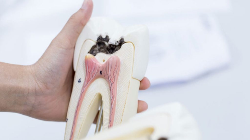 A Person Holding A Model Of A Tooth With Cavity